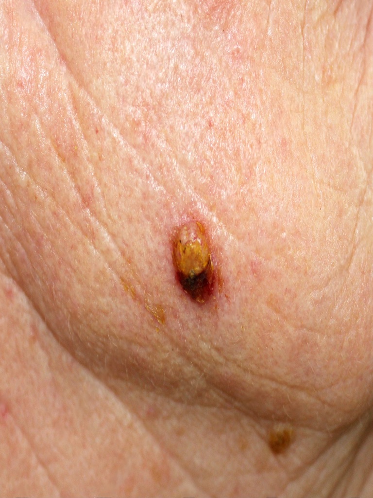 Best Basal Cell Cancer Treatment in Altrincham, UK