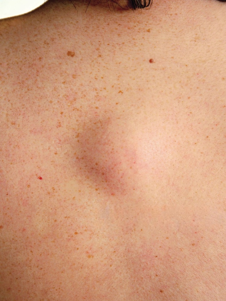 Best Lipoma Treatment in Altrincham, UK