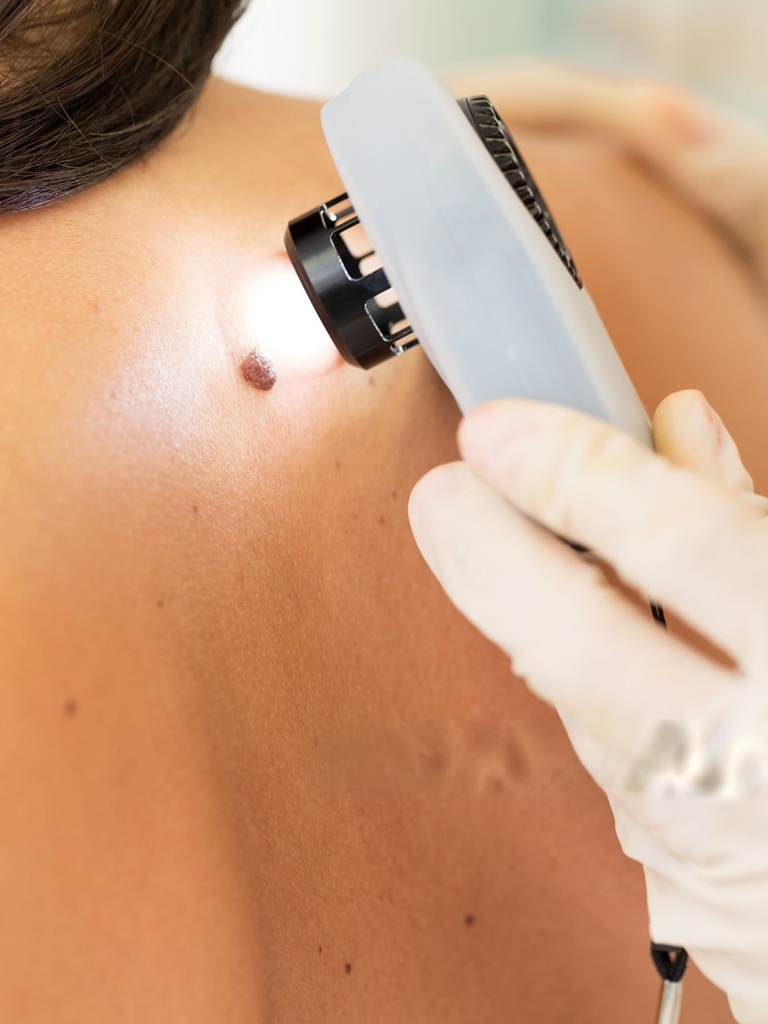 Best Malignant Melanoma Treatment in Altrincham, UK