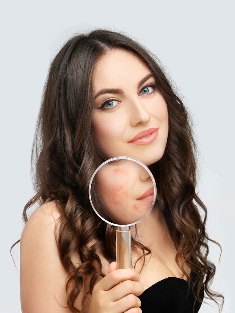 acne scar at Bollin Clinic