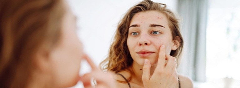 Best Acne Treatment in Altrincham, UK
