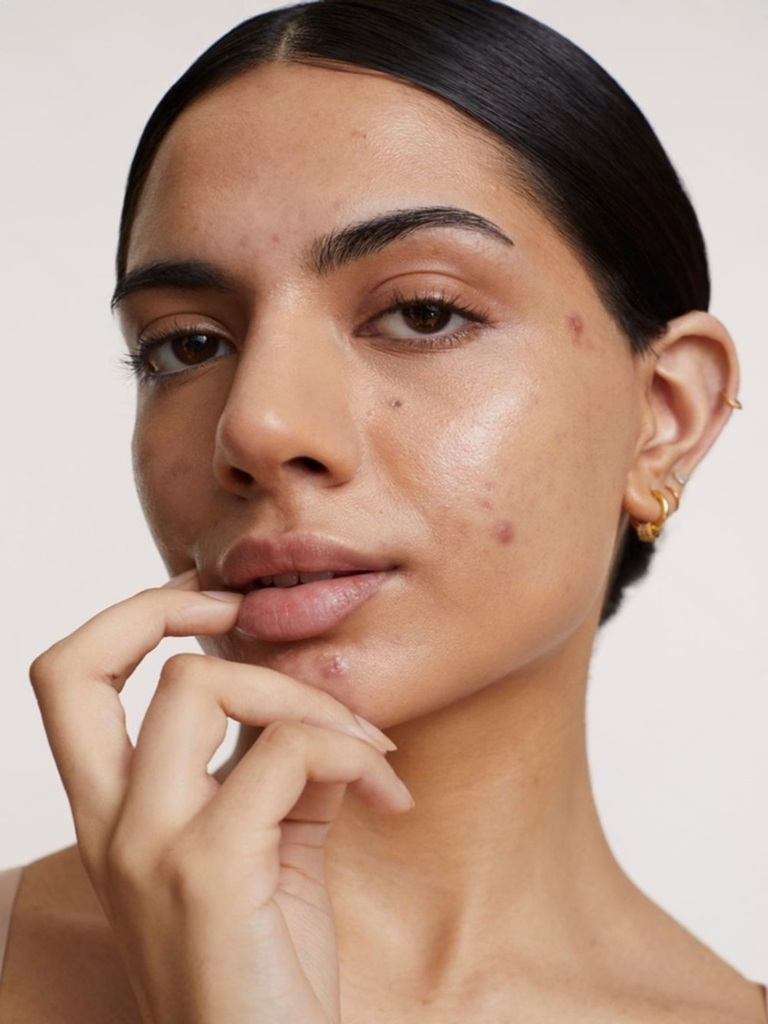 Best Acne Treatment in Altrincham, UK